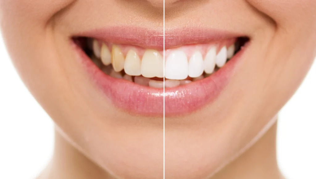 Teeth whitening (Tooth Bleaching)