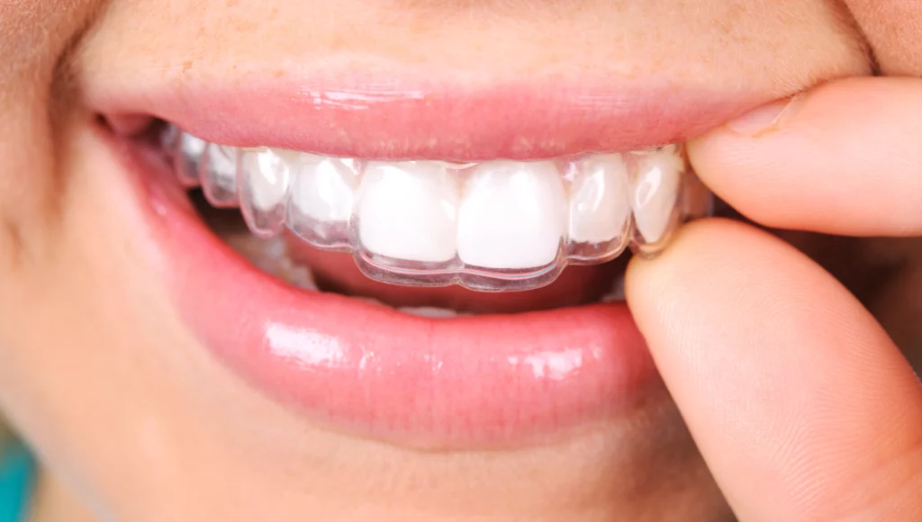  Invisalign
