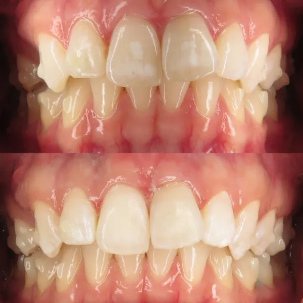 before after teeth cleaning | Your Dentist in Long Island City, NY