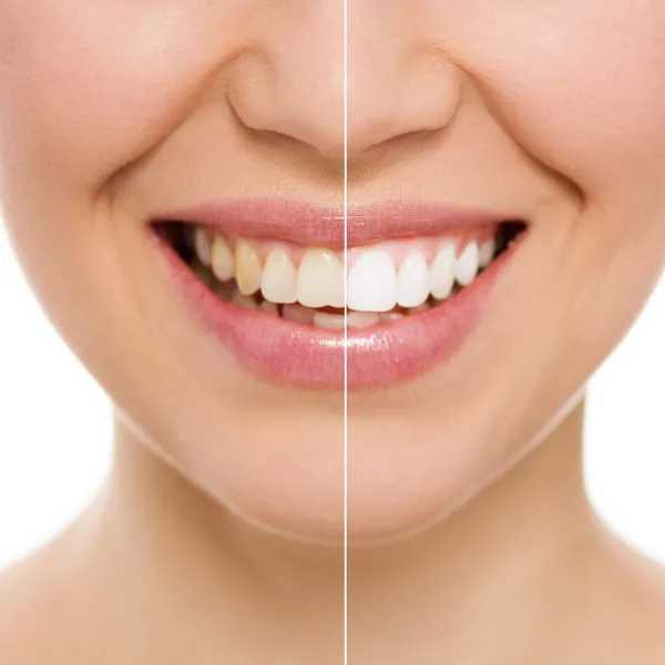 Before After | Your Dentist in Long Island City, NY